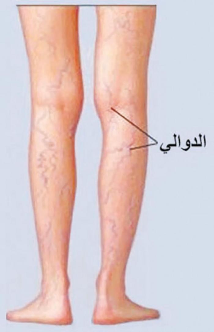 8 طرق للوقاية من دوالي الساقين
