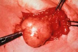 دراسة إكلينيكية تفتح الباب أمام علاج أورام الثدى
