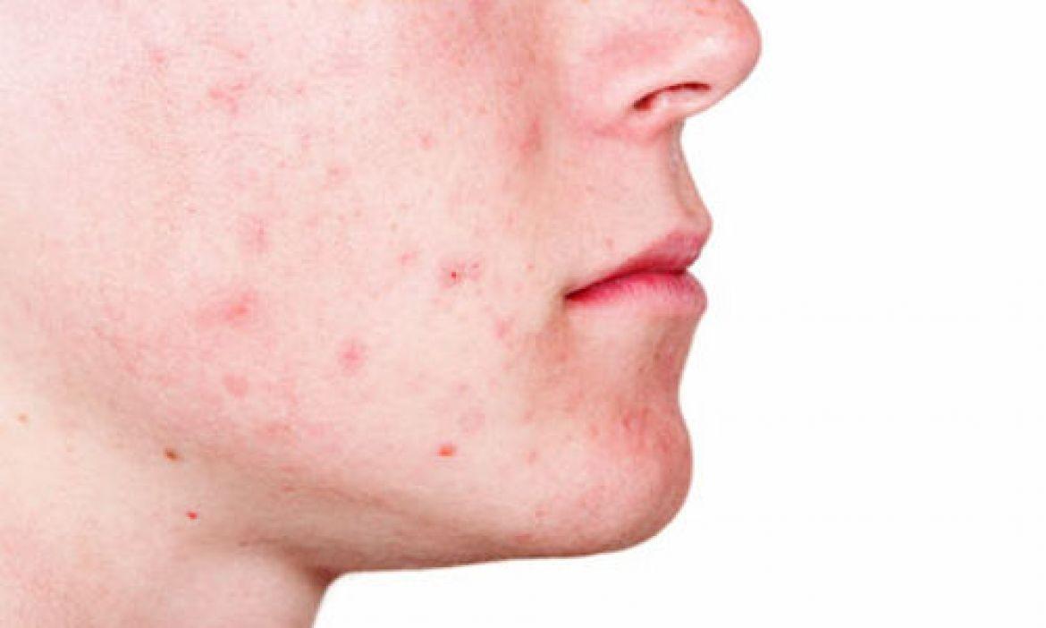 7 وصفات طبيعية لعلاج حب الشباب