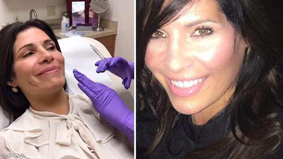 سيدة تجري 8 عمليات تجميل لتشبه «ميلانيا ترامب»
