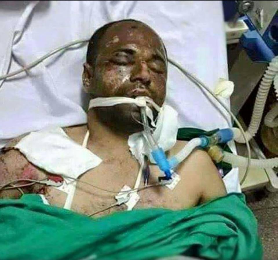 معتقل بدمنهور يعاني من تعفن في القدم واليد.. والنيابة: عايزك تفضل كده