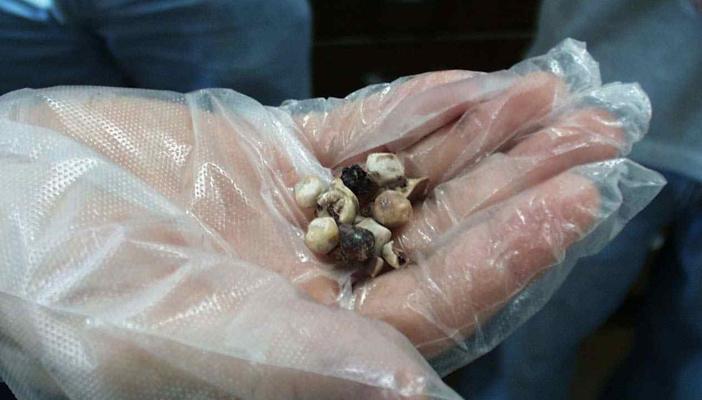 الموجات فوق الصوتية.. أحدث وسيلة للتخلص من حصى المرارة دون جراحة