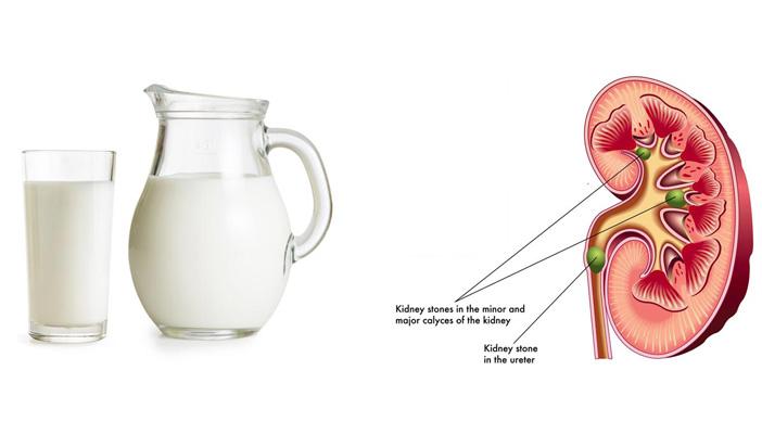 دراسة: زيادة الكالسيوم تسبب حصوات الكلى