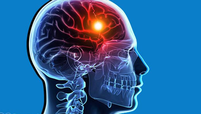 دراسات: 5 أشياء تسبب 80% من احتمالات الإصابة بالجلطات الدماغية