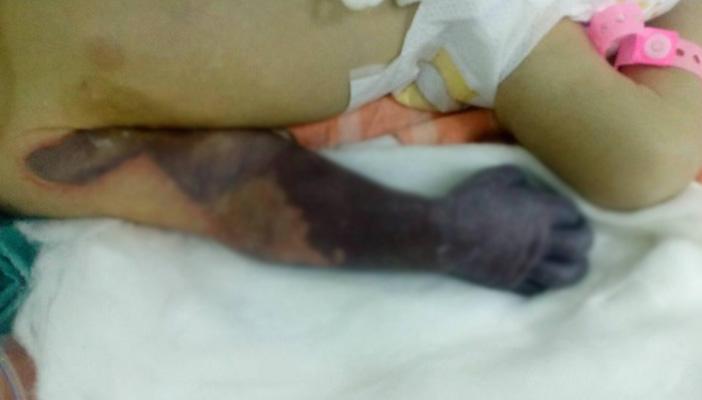 مأساة بتر ذراع طفل رضيع داخل إحدى حضَّانات كفر الشيخ