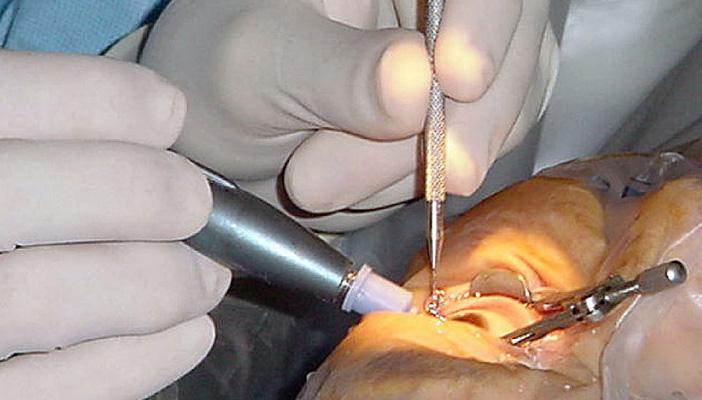 تركيا الأولي عالميًا في جراحة العيون