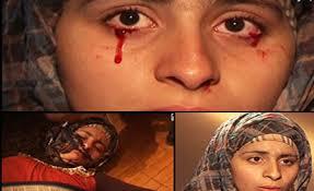 عبدالله الشريف: “الدموع الدموية” مرض معروف في الغرب