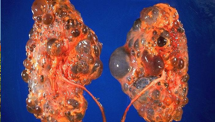 10 أعراض تشير إلى الإصابة بمرض الكلى