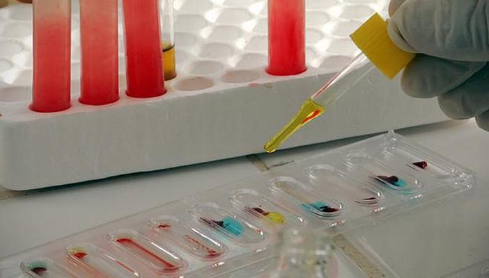 علماء يتوصلون لطريقة تمنع تطور مرض “الإيدز”