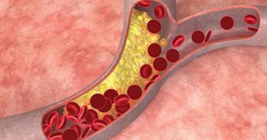 أهم 10 علامات للإصابة بالأنيميا