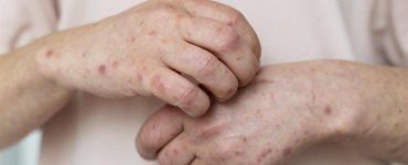 جدري القردة